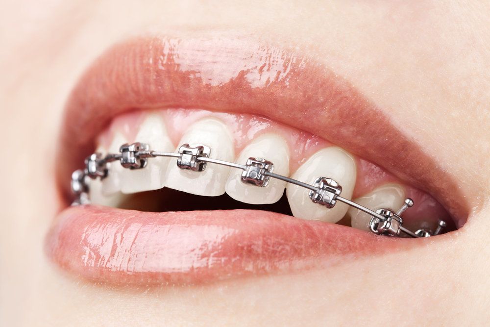 Tooth Braces in Umina Beach & the Central Coast