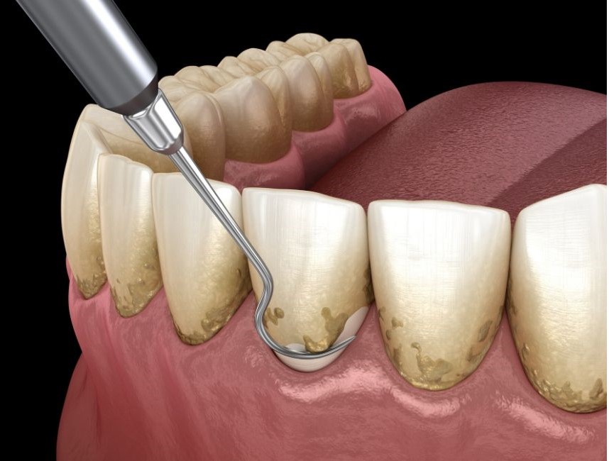 Periodontal maintenance is essential for patients who have been treated for gum disease. Periodontist Central Coast and Umina Beach. Periodontal Disease Treatment Central Coast and Treatment Umina Beach