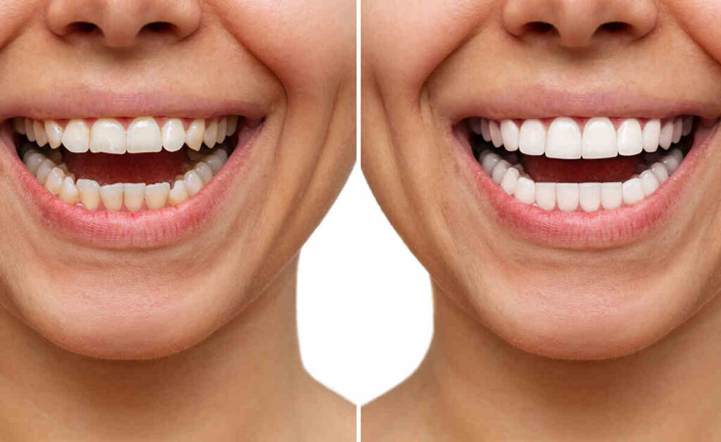 Teeth Reshaping, Cosmetic Dentistry Central Coast and Umina Beach. Tooth Reshaping Central Coast and Umina Beach