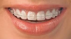 Orthodontic Treatments in Umina Beach and Central Coast