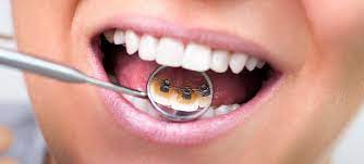 Orthodontic Treatments in Umina Beach and Central Coast Hidden behind the teeth for a discreet treatment option.