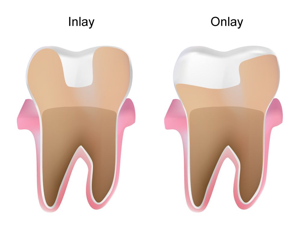 Custom inlay placed on damaged tooth in Central Coast and Umina Beach clinic