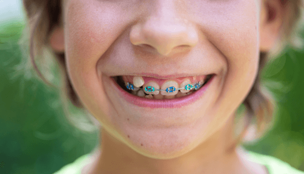 Orthodontic Treatments in Umina Beach and Central Coast At Central Coast Smiles, we provide gentle, preventive orthodontic care to help your child achieve a healthy bite and confident smile.