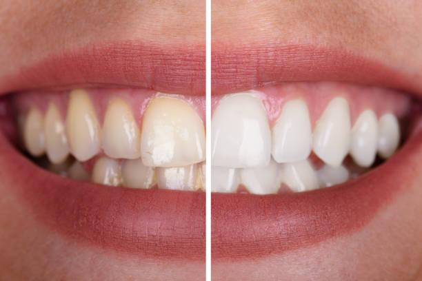 Teeth Whitening Central Coast and Umina Beach, Teeth Whitening Dentist Central Coast and Umina Beach