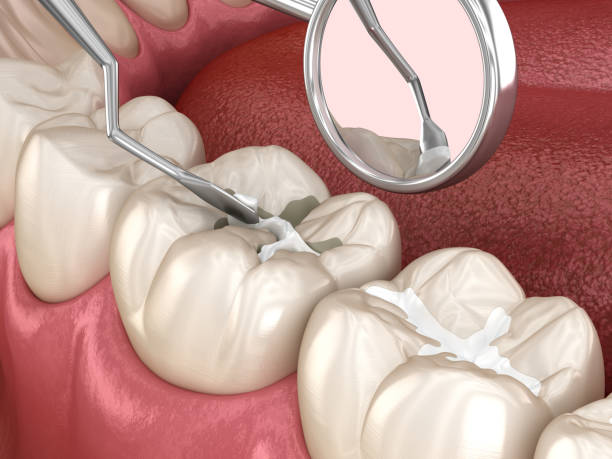 Protective sealant applied on molars to prevent tooth decay in Umina Beach and Central Coast