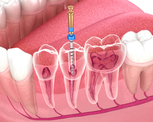 Root canal therapy is a highly effective treatment used to remove infection from inside a tooth and preserve its structure. Root Canal Therapy in Central Coast and Umina Beach