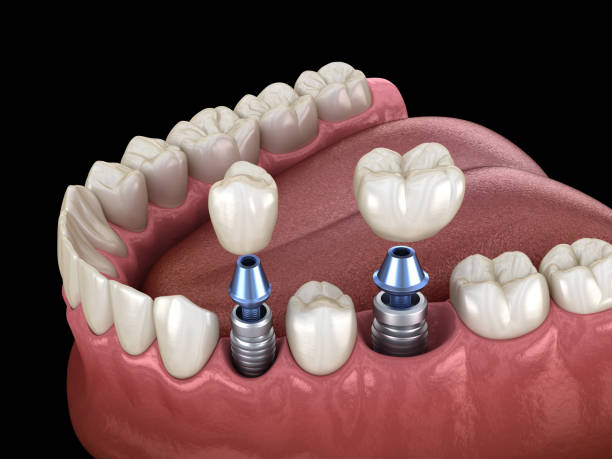Dental implant being surgically placed into the jawbone in Umina Beach and Central Coast