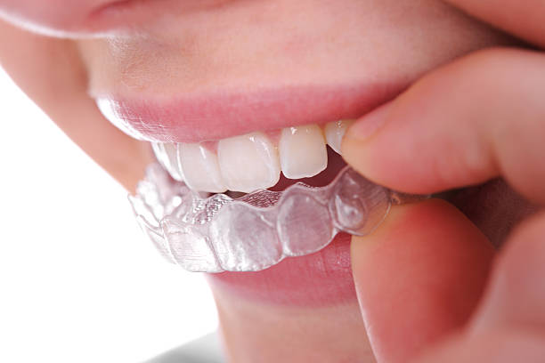 Custom Night Guards for Teeth Grinding in Umina Beach and the Central Coast Teeth Retainers Central Coast and Umina Beach At Central Coast Smiles, we provide custom-made retainers that comfortably hold your teeth in place, ensuring long-term results.