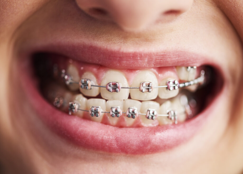 Shot of child's teeth with braces Orthodontic Treatments in Umina Beach and Central Coast