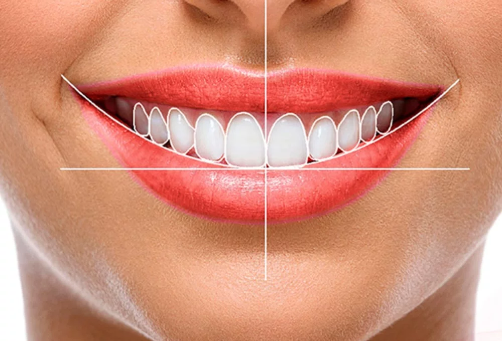 Smile Makeovers, Cosmetic Dentistry Central Coast and Umina Beach. Tooth Reshaping Central Coast and Umina Beach