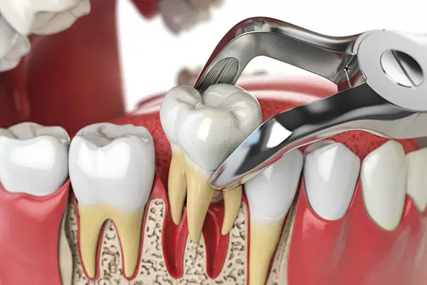 Tooth extractions may be recommended when a tooth is damaged beyond repair or if wisdom teeth are impacted or causing discomfort. Tooth Extractions Umina Beach and Central Coast