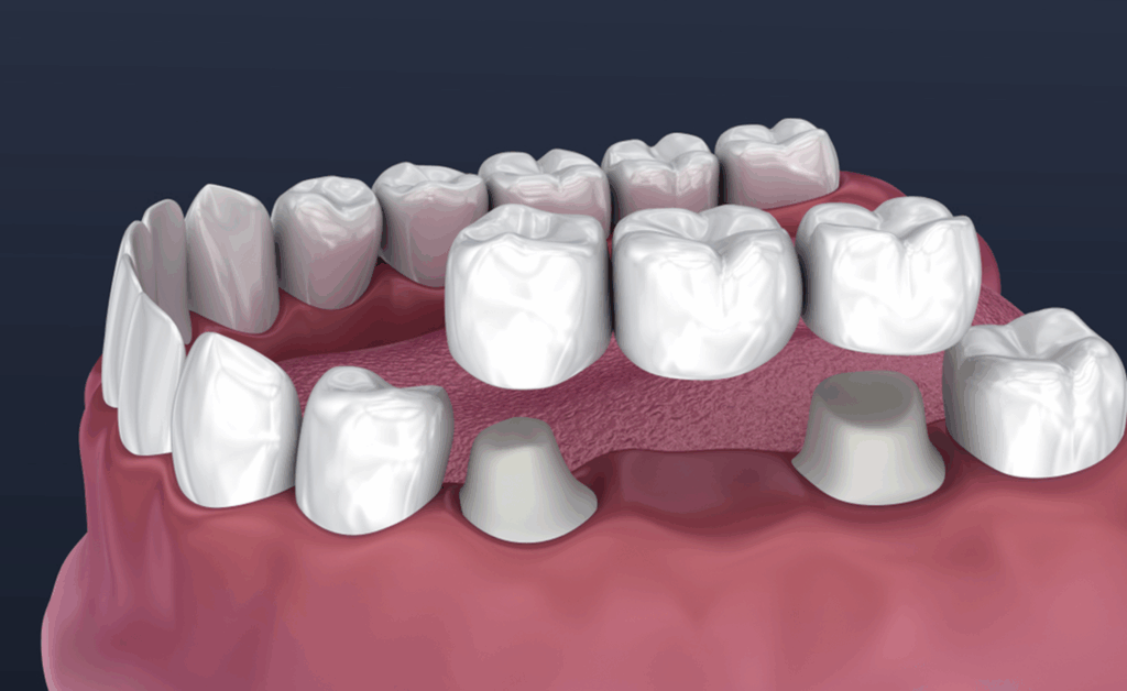 Prosthodontist Central Coast and Umina Beach, Prosthodontic Dentistry Central Coast and Umina Beach Complete and Partial Dentures Dentures are custom-made prosthetic devices used to replace missing teeth and restore your ability to chew, speak, and smile with ease.